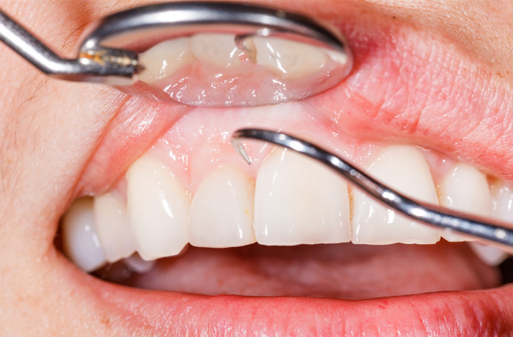 Close-up of Hamilton dentist examining patient's inflamed gums
