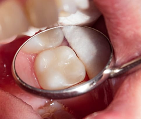 Natural looking white fillings viewed through dental mirror by Hamilton dentist