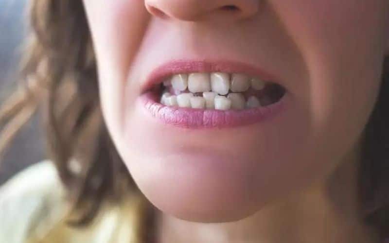 Misaligned & Crooked Teeth Can Lead To Further Complications