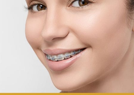 A woman smiles with braces, showcasing her transformation from cosmetic dentistry.