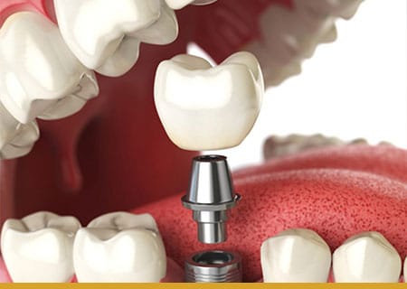 A dental implant is being placed in a patient's mouth as part of cosmetic dentistry.