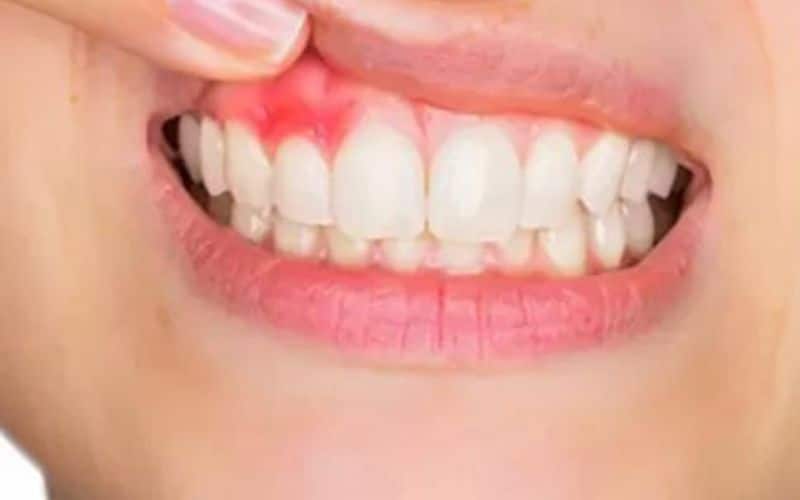 Inflamed gums requiring bone & gum grafting treatment