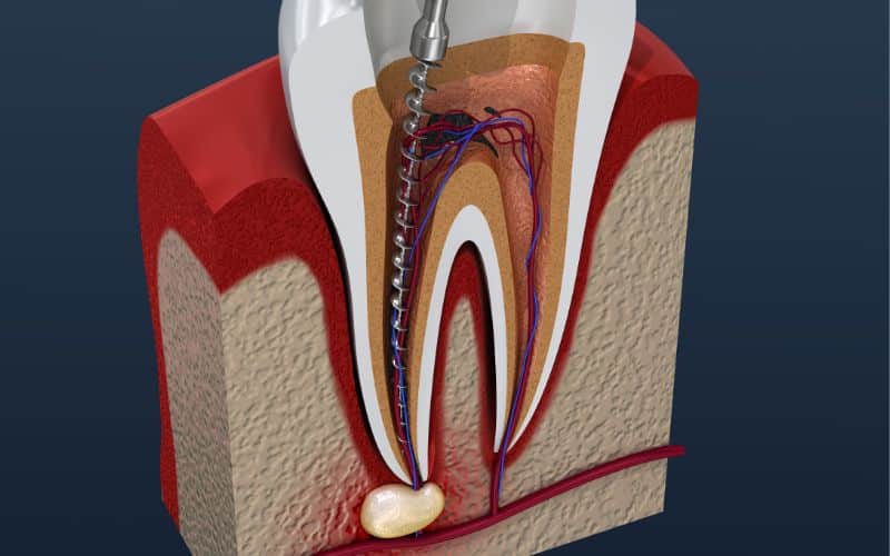 What Is Root Canal Treatment