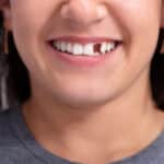 Dental Restoration Options for Damaged or Missing Teeth