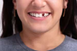Dental Restoration Options for Damaged or Missing Teeth