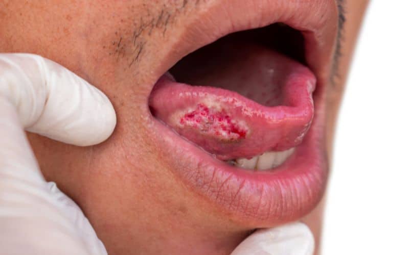 A man's tongue with a red spot, indicating possible oral problems.