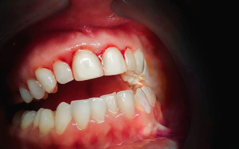 A close up of a person's mouth with missing teeth, indicating oral problems.