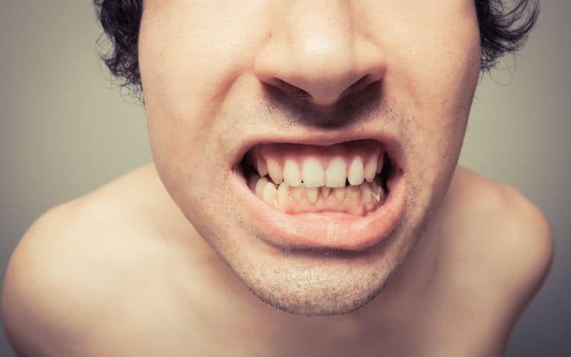 A close up of a man showing signs of tooth decay with his mouth open.