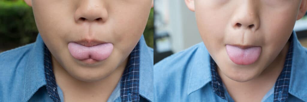 Asian boy with tongue tie, pre operation.