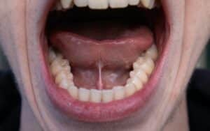 Ankyloglossia (Tongue Tied) in adult male mouth