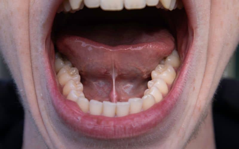 Ankyloglossia (Tongue Tied) in adult male mouth