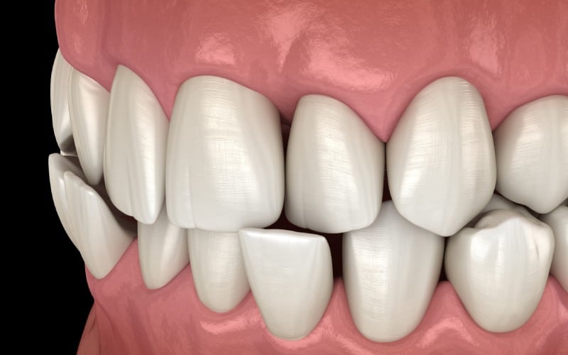 anterior crossbite dental occlusion malocclusion teeth medically accurate tooth illustration