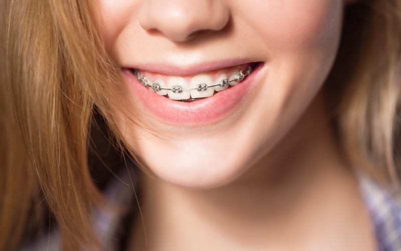 portrait of teen girl showing dental braces