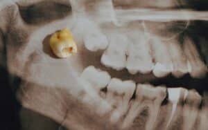 X-ray image of a set of teeth with a removed tooth placed on top, illustrating the process of wisdom teeth removal.