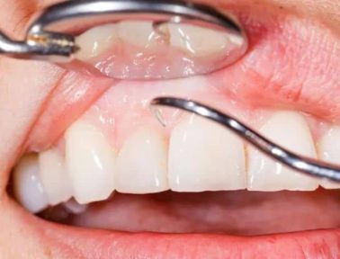 Close-up of Hamilton dentist examining patient's inflamed gums