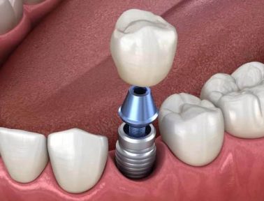 Dental Implant Cost and Benefits