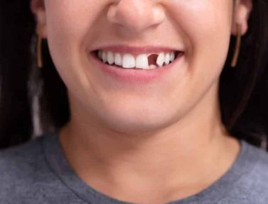 Dental Restoration Options for Damaged or Missing Teeth