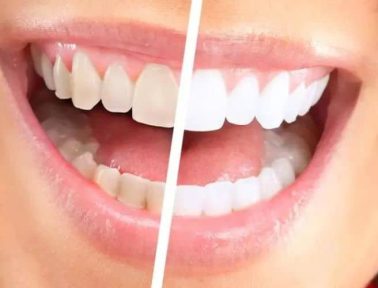 How Long Does Teeth Whitening Last