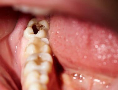 Damaged tooth with cavity dental caries decay