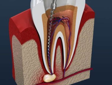 What Is Root Canal Treatment