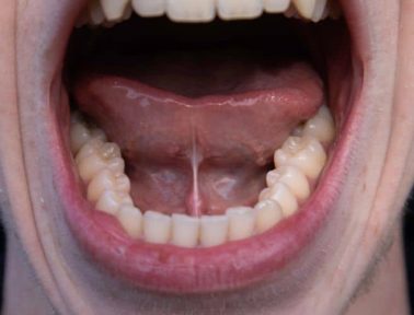 Ankyloglossia (Tongue Tied) in adult male mouth
