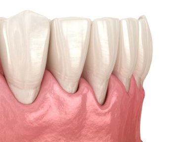 gum recession process medically accurate illustration