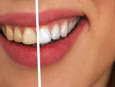 how to whiten your teeth