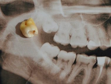 X-ray image of a set of teeth with a removed tooth placed on top, illustrating the process of wisdom teeth removal.