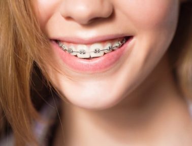 portrait of teen girl showing dental braces